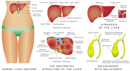 Liver and Gallbladder. Cirrhosis. Major anatomical landmarks and four lobes of liver. Anatomical structure of liver, gallbladder and bile ducts. Interior of gallbladder. Gallbladder with gallstonesのイラスト素材