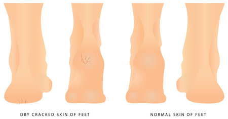 Cracks on Heels. Female legs with cracks. Concept of foot fungus with cracked heel. Groomed dry skin on feet and heels.のイラスト素材