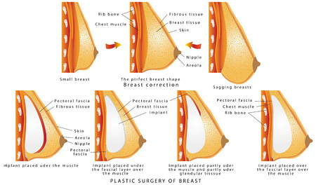 Plastic surgery of breast. Diagram about method of insertion for breast implant. Cosmetic surgery illustration. Anatomy of the breast and implants. The rise and increase of breast plastic surgeryのイラスト素材