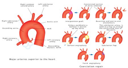 Coarctation repair. Coarctation of Aorta, congenital defect of the aorta (narrowing of the aortic arch). Major surgical aortic coarctation repair techniques.のイラスト素材