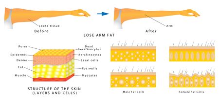 Lose arm fat. Subcutaneous fat distribution in human. Anatomy of Human Skin layer and arm. Women with arm imbalance of body fat.のイラスト素材