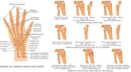 Wrist Fractures. Diagram of wrist have bone fracture. Broken arm bone view show fracture of ulna and radius bone.のイラスト素材