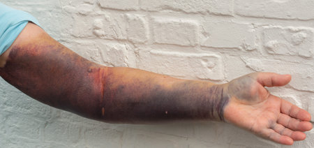 Bruise on the whole arm and at elbow break