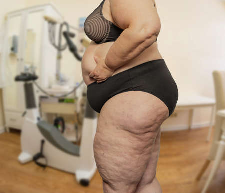 Woman with obesity and cellulite in a treatment room with a doctorの写真素材