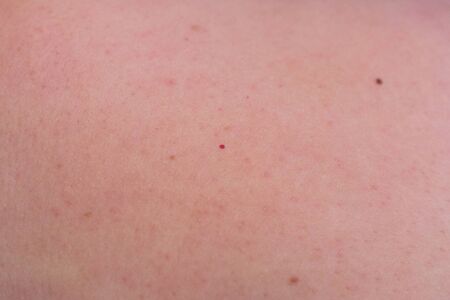 Woman with birthmarks on her skin, Skin tags removal.の写真素材