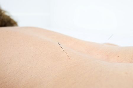 Acupuncture needle in the human skin .の写真素材