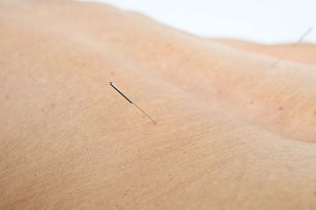 Acupuncture needle in the human skin .の写真素材