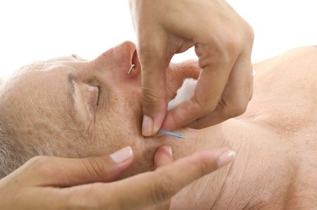 Acupuncture - Application of needles in senior at the spa .の写真素材