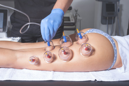 closeup of therapist hand placing vacuum cups on woman thigh back side