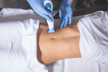 woman body fractional treatment at medical spa center