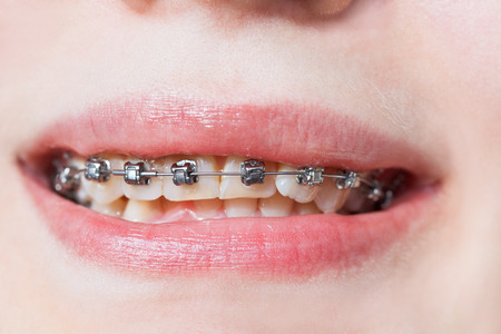 front view of dental braces on teeth of upper jaw before Orthodontic Treatmentの写真素材