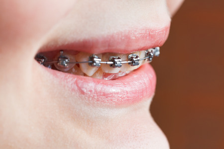 dental braces on teeth of upper jaw close up before Orthodontic Treatmentの写真素材