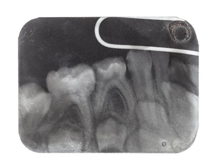 Film with X-ray image of human teeth close up isolated on white