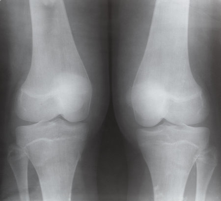 Front view of two human knee joints on X-ray image