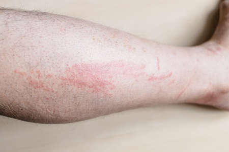 sample of Allergic contact dermatitis - side of male shin with itchy red rashの写真素材