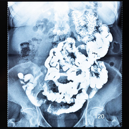 X-ray radiogram with Barium study of small bowel after 120 minutes (two hours) after the start of...