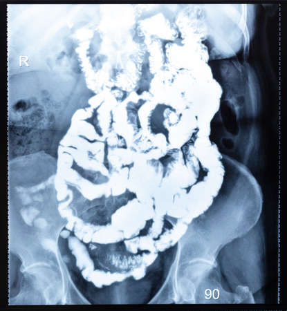 X-ray radiogram with Barium study of small bowel after 90 (ninety) minutes after the start of passage procedureの写真素材