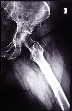 negative x-ray side view of junction of tibia and pelvis after healed of fracture of acetabular cavityの写真素材