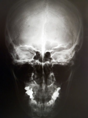 X-ray image of human skullの写真素材