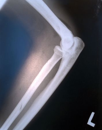 X-ray of knee, profileの写真素材