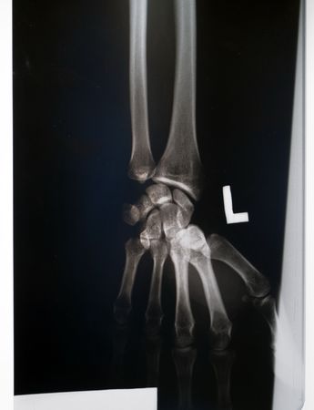 X-ray of wristの写真素材
