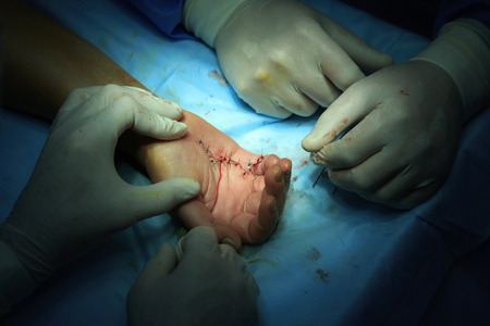 surgeons finished the surgery on a handの写真素材