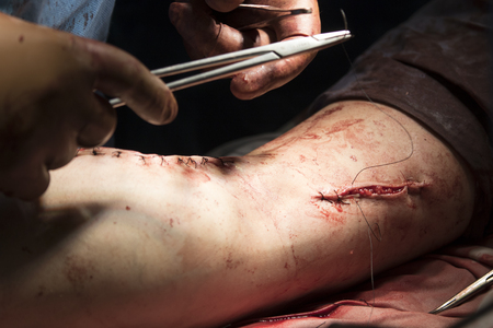 Surgeon sews the wound on the leg after the surgeryの写真素材