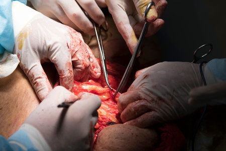 Surgery detail of removal excess fat and skin