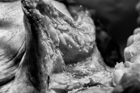 Excess subcutaneous fat close-up