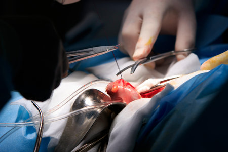 surgery close-up with surgeon cuts off the thread with scissors during making of stoma