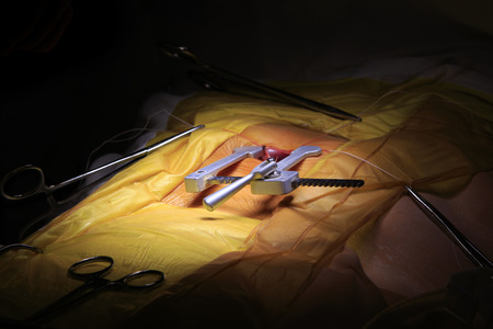 Rib spreader installed into a thorax during the cardiac surgery closeupの写真素材