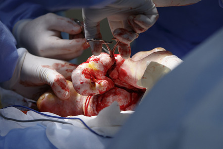 Surgeon cuts the tissues of a finger on mutated hand close upの写真素材