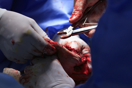 Surgery close-up with surgical nippers in surgeon's hand and blood jet sprays from the woundの写真素材