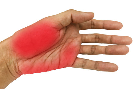Inflame muscle on the hand ,Inflame muscle on the back handの写真素材