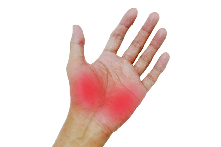Inflame muscle on the hand ,Inflame muscle on the back handの写真素材