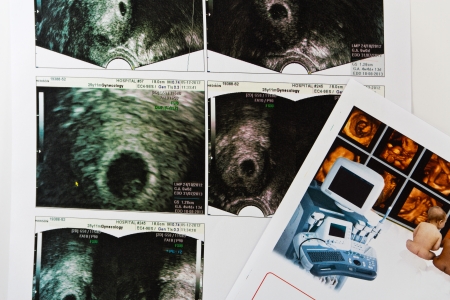 Real ultrasound images of 2D,3D and 4D.