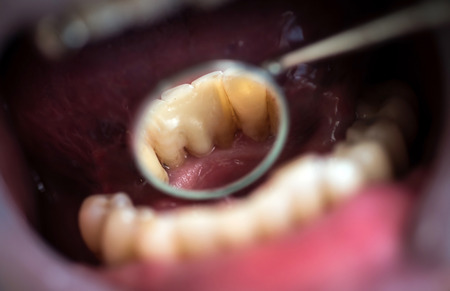 Resin crown for temporary treatment, that are used in cases when the patient has to walk away with buffed teeth from the dentist. These have protective role on teeth, with less regard on aesteticsの写真素材