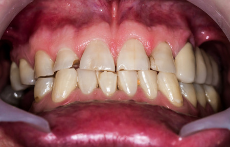 Patient's mouth before entire dental treatment and changesの写真素材