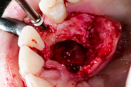 dental implant placement in real pacient.の写真素材
