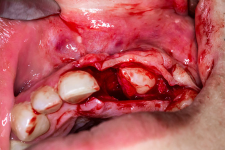 Tooth extractionの写真素材