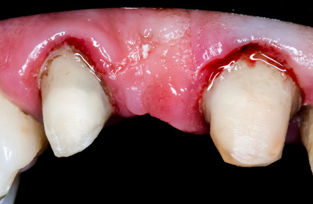 Picture of human teeth during dental treatmentの写真素材