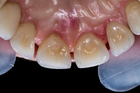The final result of the treatment of a broken incisors.