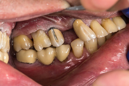 Patient's mouth before entire dental treatment and changes