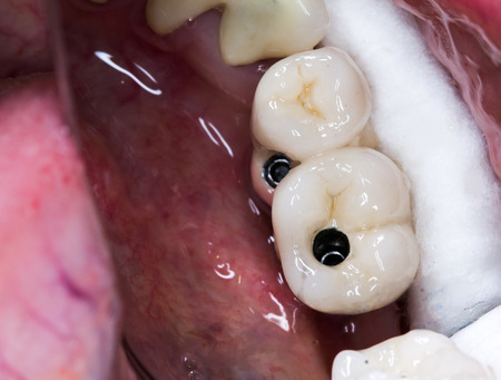 dental implant crowns placement in real pacient.