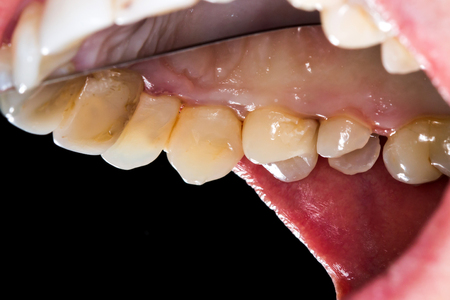 The molar in course of restoration.の写真素材