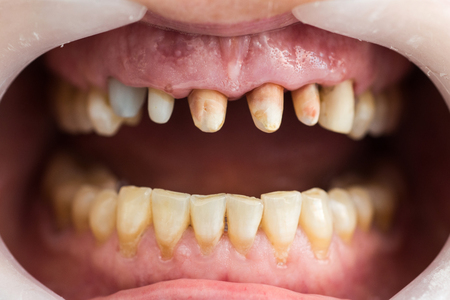 Picture of human teeth during dental treatment.
