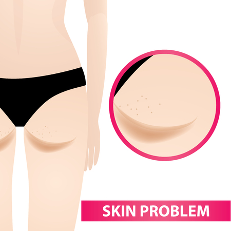 Dark skin on bottom problem.のイラスト素材
