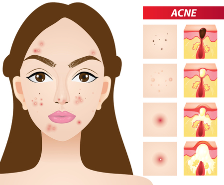 Types of acne vector illustrationのイラスト素材