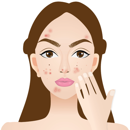 Types of acne , skin problems vector illustrationのイラスト素材