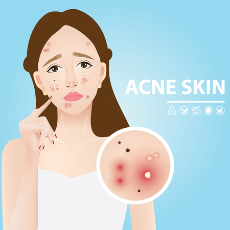 Acne skin vector illustrationのイラスト素材